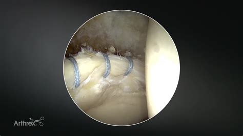 Arthrex Acetabular Labral Repair Using The Mm Knotless Hip