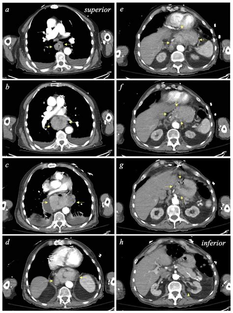 Computed Tomography Ct Scans Of The Chest Abdomen And Pelvis With