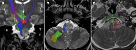 Diffusion tensor imaging (DTI) tractography in brainstem cavernoma ...