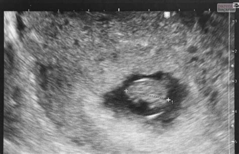 Ultrasound Week 7 All The Things That No One Will Tell You