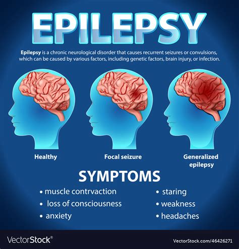 Informative Poster Of Epilepsy Royalty Free Vector Image