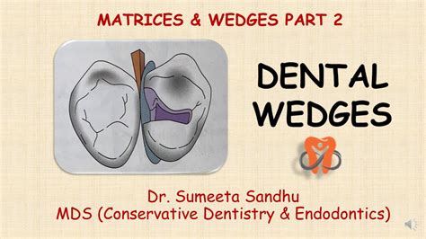 Dental Wedges Matrices Wedges Part Wedge Placement Short Notes