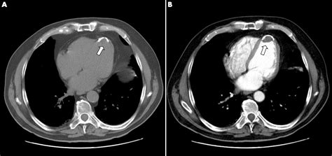 Calcified Left Ventricular Aneurysm With Delayed Thrombus Formation