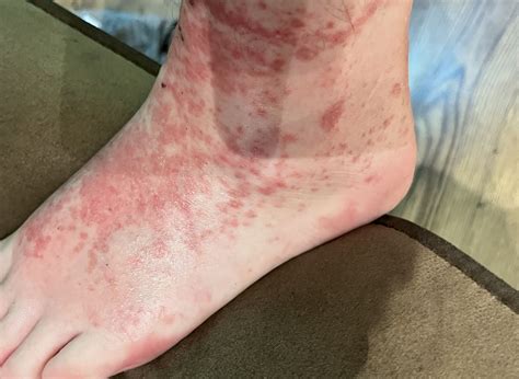 I Loved My 4 Vinted Trainers Until I Broke Out In A Horrific Rash