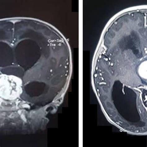 Preoperative Coronal And Axial Postcontrast T1 Weighted Mri Images The