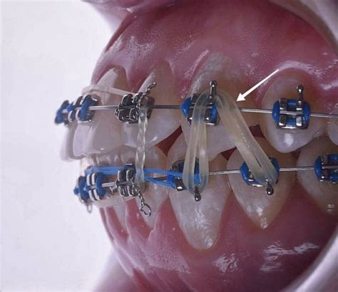 Dental elastics put continuous forces onto the teeth and cause teeth ...