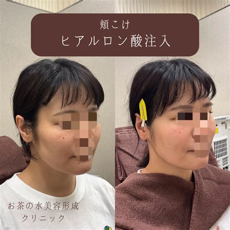 頬コケを改善してアンチエイジング！！ 御茶ノ水の美容皮膚科｜お茶の水美容形成クリニック