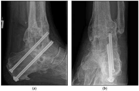 JCM Free Full Text Septic History Limits The Outcome Of