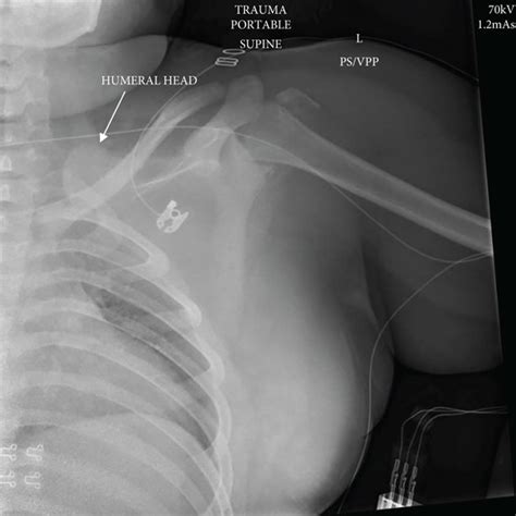 A Anteroposterior X Ray Of The Left Shoulder B Anteroposterior Download Scientific Diagram