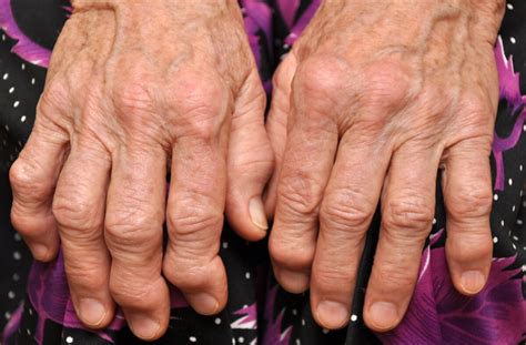 Arthritis Symptome Und Anzeichen F R Eine Gelenkentz Ndung Was Tun