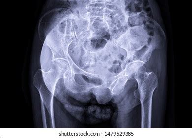 Xray Image Show Both Hip Pelvis Stock Photo 1479529385 Shutterstock