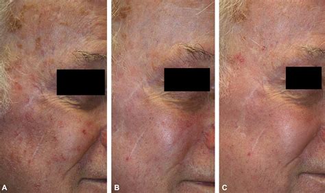 Nonablative Fractional Photothermolysis For Facial Actinic Keratoses 6