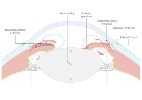 Peripheral Anterior Synechiae