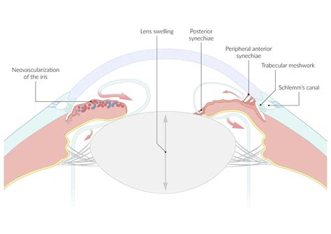 Peripheral Anterior Synechiae