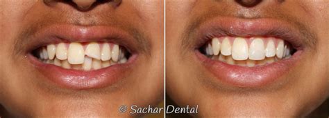 Cosmetic Dentist Nyc Sachar Dental Nyc Before After Pictures