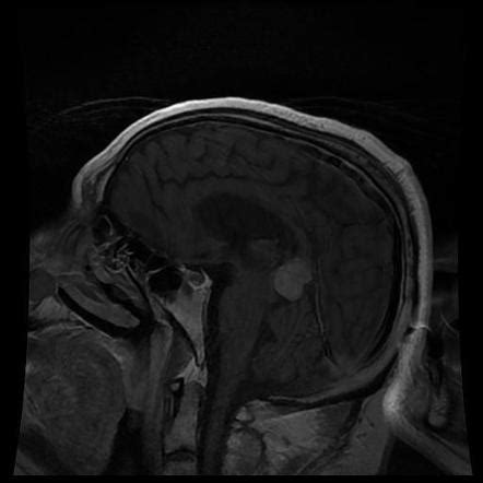 Solitary Fibrous Tumor Hemangiopericytoma Image Radiopaedia Org