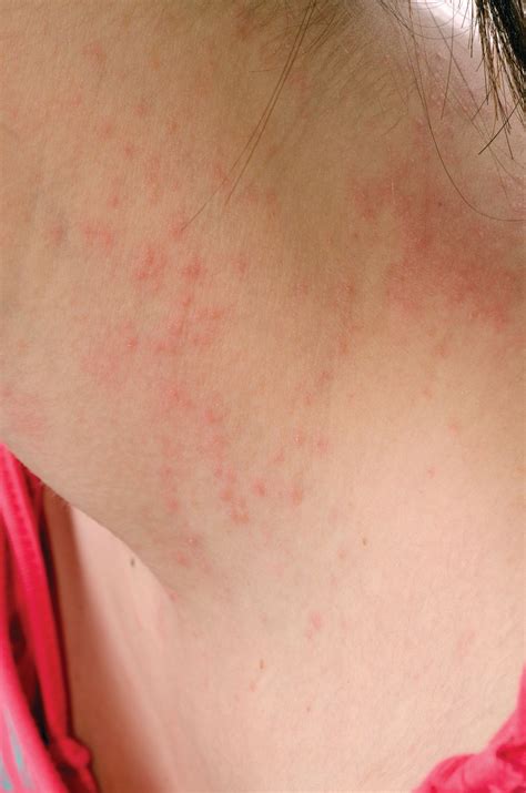 Systemic Treatment For Atopic Dermatitis