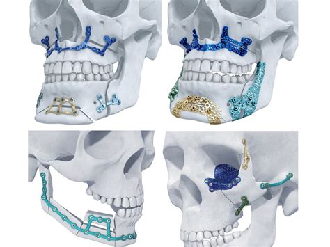 Depuy Synthes Rolls Out 3d Printed Facial Implants From Materialise Fierce Biotech