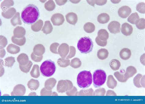 Mancha De La Sangre De La Leucemia Linfocítica Crónica Imagen de