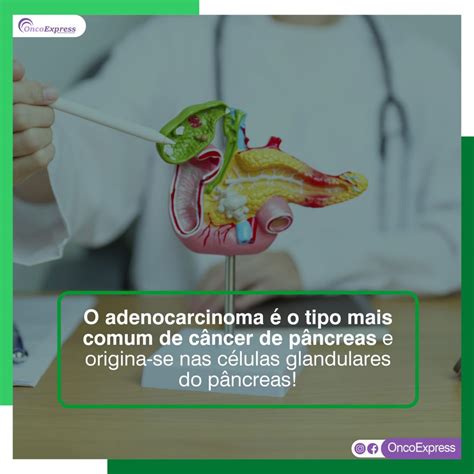 O adenocarcinoma é o tipo mais comum de câncer de pâncreas e origina se