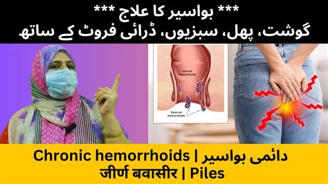 Chronic Hemorrhoids دائمی بواسیر Bawasir जीर्ण बवासीर Piles