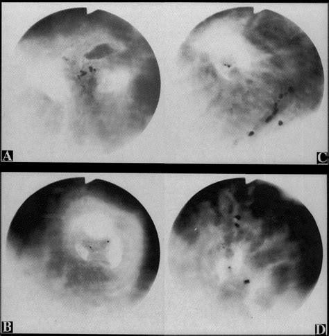 Figure The Bronchoscopic Findings Of The Four Lesions Showed Swelling