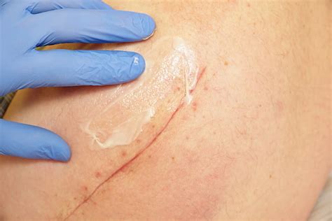 Massaging A Scar After Mohs Surgery When Can You Do It Dermatology