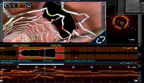 Coronary Imaging Dr S Venkatesan Md