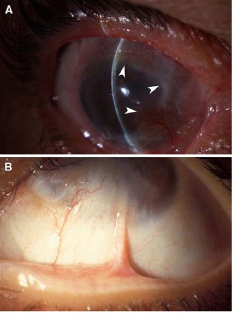 Stage 1 Partial Limbal Stem Cell Deficiency A Conjunctival