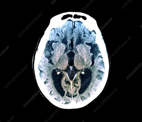 Alzheimers Disease Ct Brain Scan Stock Image C0388775 Science