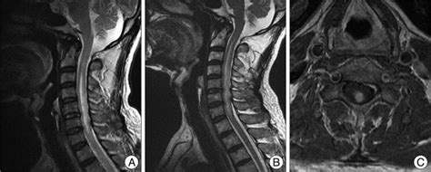 A A T2 Weighted Magnetic Resonance MR Sagittal Image Shows A High