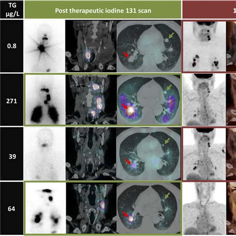 (PDF) Restoring Radioiodine Uptake in BRAF V600E–Mutated Papillary Thyroid Cancer