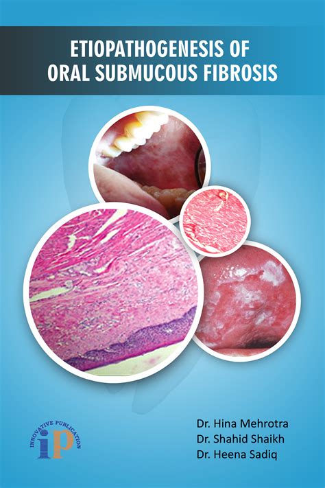 Oral Submucous Fibrosis Histopathology