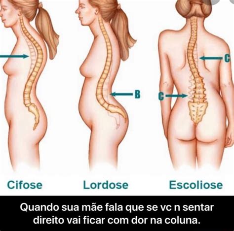 Cifose Lordose Escoliose Quando sua mãe fala que se vc n sentar direito