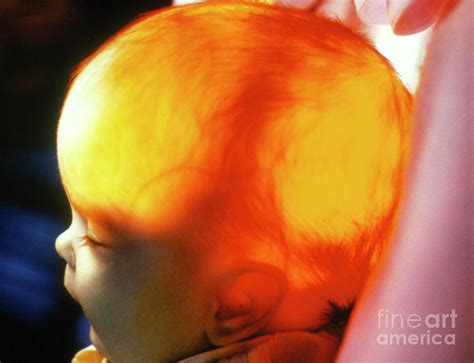 Transillumination Of Babys Head In Hydrocephalus Photograph By Alfred