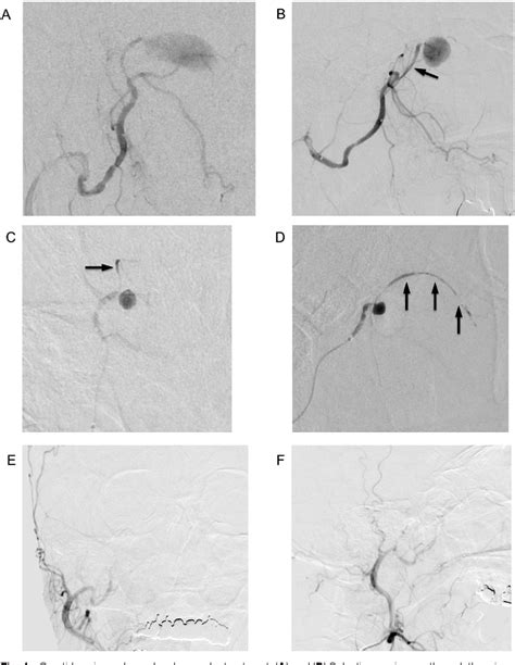 Figure From Traumatic Pseudoaneurysm In Maxillary Sinus Presenting