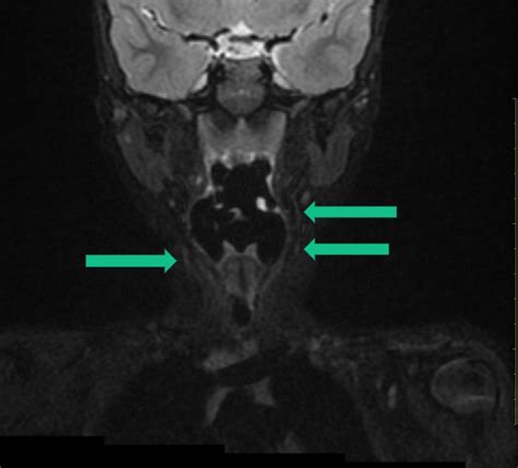 Fourth Branchial Cleft Cyst And Fistula Image