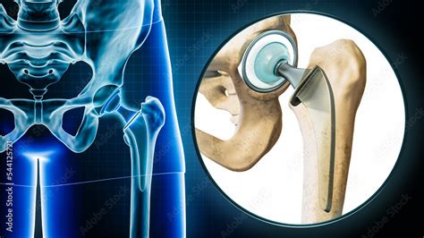 Femoral Head Hip Prosthesis Or Implant X Ray With Magnification Or