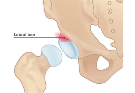 Hip Labral Tears Range Physiotherapy