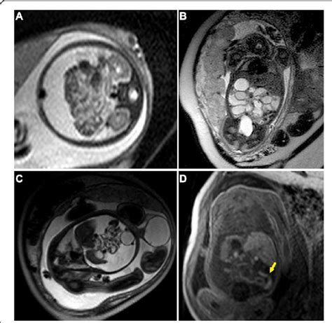 Fetal Mri Findings Of Meconium Peritonitis In Two Fetuses Receiving