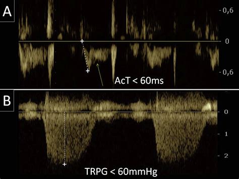 Echocardiographic Pattern Of Acute Pulmonary Embolism Analysis Of 511