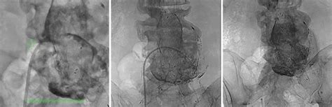 Novel Approach To Transcaval Type Ii Endoleak Embolization