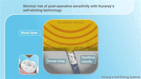 Kuraray Self Etch Demonstration Dental Use Youtube