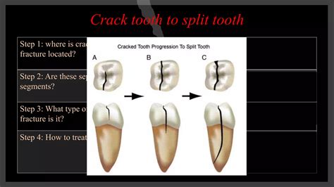 Management Of Tooth Fracture Ppt