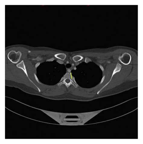 A Axial Contrast Enhanced Ct Images Cta Neck Demonstrate The