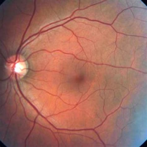 Normal RNFL thickness in optical coherence tomography. ONH = optic ...