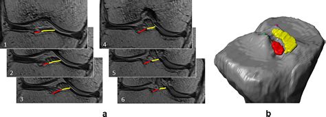 Relationship Between Anterior Cruciate Ligament And Anterolateral