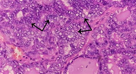 Thyroid Cancer Microscopic Image Of Metastatic Papillary Carcinoma Of