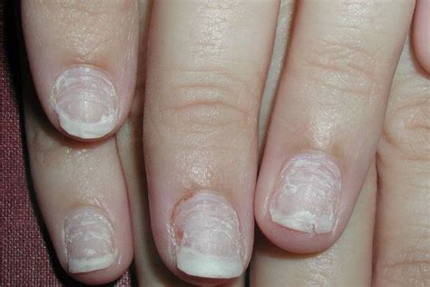 Natural Ways To Fix The Brittle And Weak Nails Strong Nails Nails