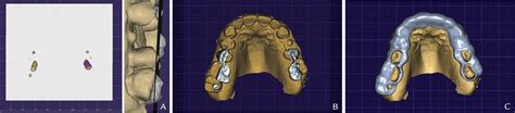 Protocol Of Facially Generated Tooth Reduction Guide Fabrication